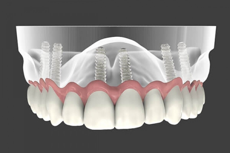 ايمپلنت دندان بهترين جايگزين