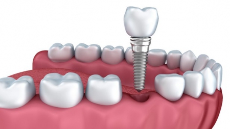 ايمپلنت دندان و نکات مراقبتي ويژه در زمان جراحي براي آن