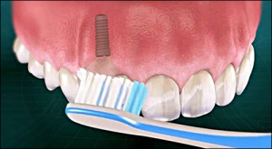 بهداشت ایمپلنت مانند دندان طبیعی