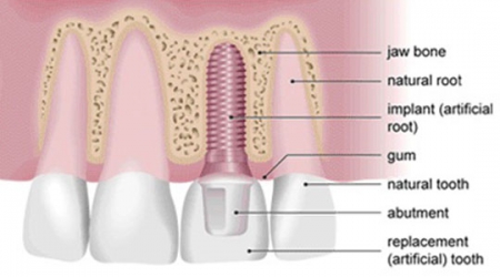 مزاياي استفاده از ايمپلنت دندان جلو