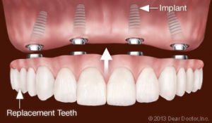  عکس ایمپلنت کاشته شده در دهان ایمپلنت فول ماوس