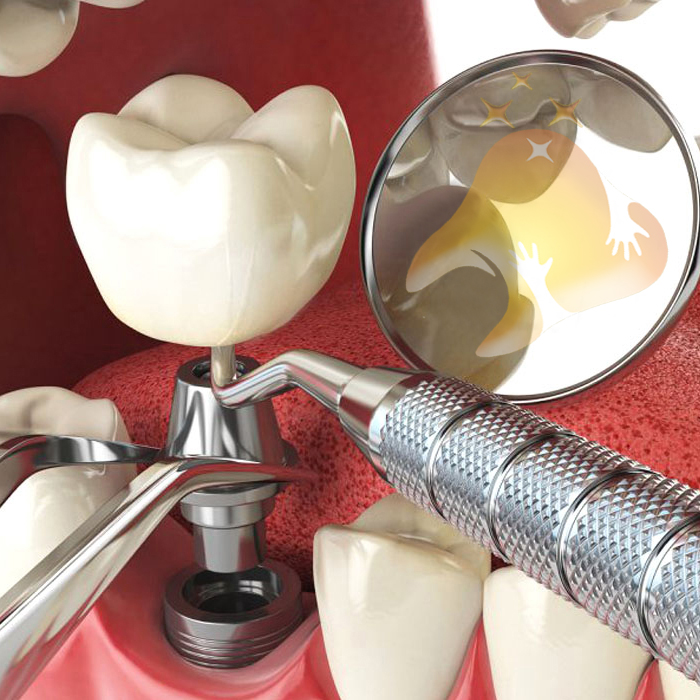  کاشت ایمپلنت دندان پروآرچ بدون نیاز به پیوند استخوان 