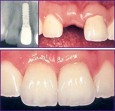 شرایط کاشت ایمپلنت دندان