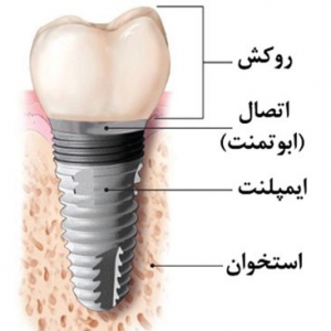 عکس از اجزای ایمپلنت دندان