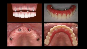 ایمپلنت دندان 