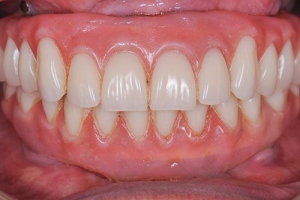 دندان ایمپلنت