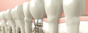 dentalna_implantaciya