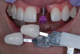 تنها روش بهبودی دندان