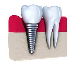 راه حل جایگزینی دندان