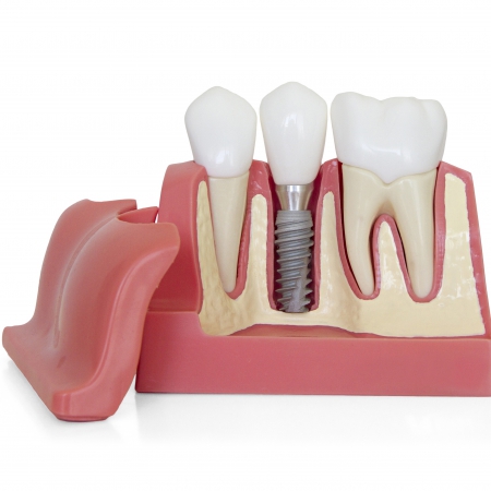 ایمپلنت دندان و شرایط استفاده