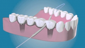  طرز استفاده از نخ دندان بعد از ایمپلنت دندان