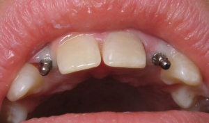 ایمپلنت دندان کوتاه