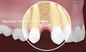 استخوان از دست رفته در ناحیه خالی دندان