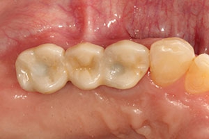 کاشت ایمپلنت دندان 