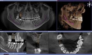 تکنیک های تصویربرداری ایمپلنت دندان