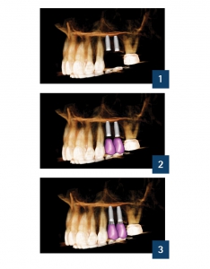 مراحل طراحی کاشت ایمپلنت دندان