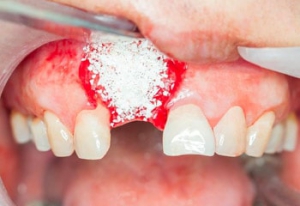 ایمپلنت دندان و پیوند استخوان