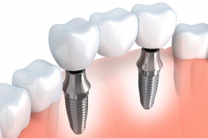 ایمپلنت های جدید در دندانپزشکی نوین