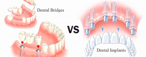 پل دندان یا ایمپلنت دندان