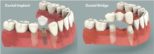  تفاوت بین ایمپلنت های دندان و پلهای دندان