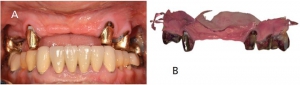 کاشت ایمپلنت دندان دیجیتال