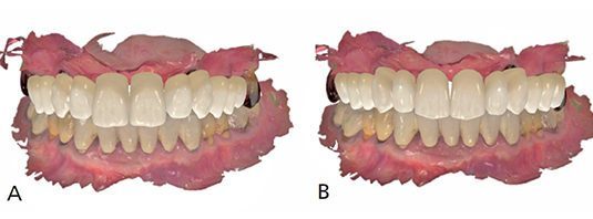 قالب ایمپلنت دیجیتال دندان