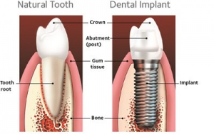 تفاوت ایمپلنت یا روکش دندان