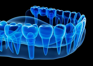 کاشت ایمپلنت دندان دیجیتال 