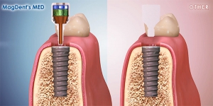 فناوری جدید ایمپلنت دندان الکترومغناطیس