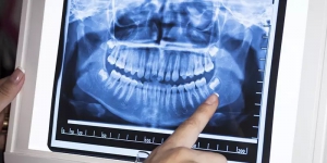 ایمپلنت دندان چاپ سه بعدی