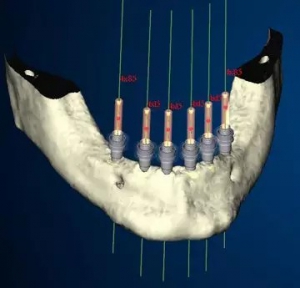 ایمپلنت های دندانی سه بعدی