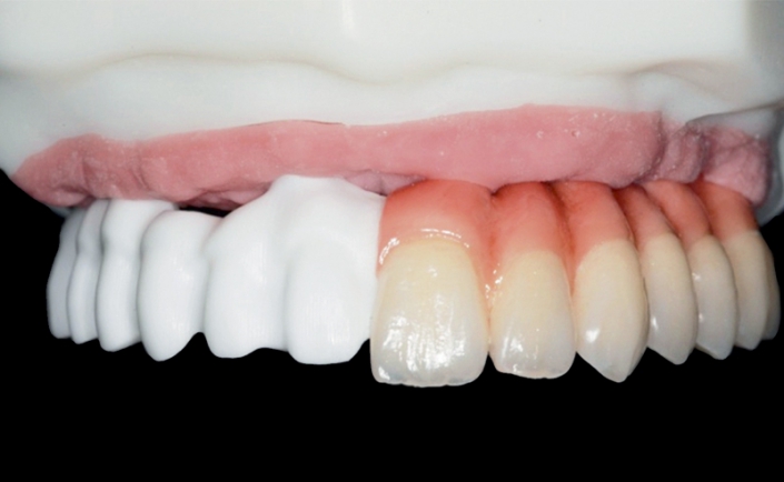 مزایا و معایب کاشت ایمپلنت های دندانی اکریلیک 