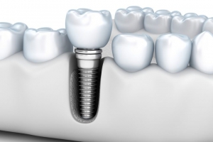 جلوگیری از آسیب ایمپلنت دندان 
