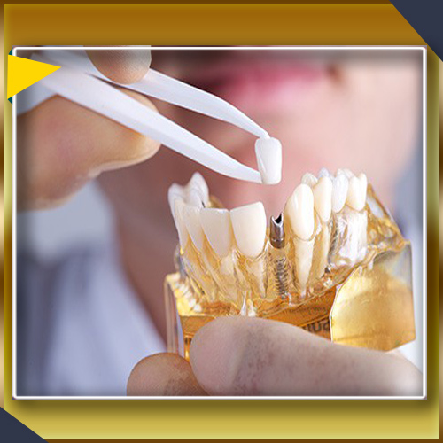 کاشت ایمپلنت دندان ریشه دندان طبیعی