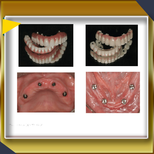 جایگزینی کامل قوس دهان با کاشت ایمپلنت دندان پروآرچ
