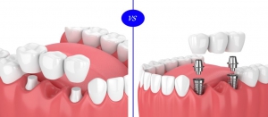  ایمپلنت های دندانی