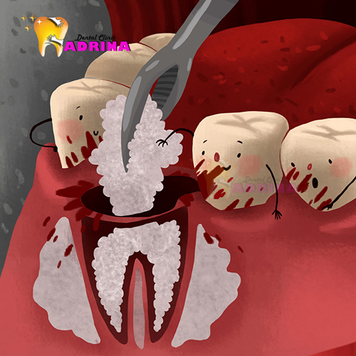جراحی پیوند استخوان برای کاشت ایمپلنت دندان
