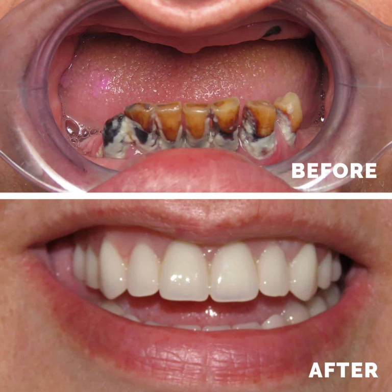 فواید لبخند و کاشت ایمپلنت دندان پیشرفته یک روزه
