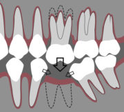 کاشت ایمپلنت دندان