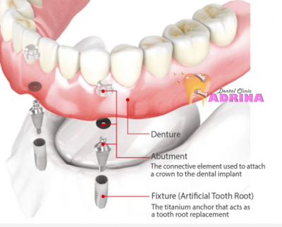 ارتباط ايمپلنت با دندان مصنوعي