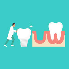 چرا ایمپلنت دندان