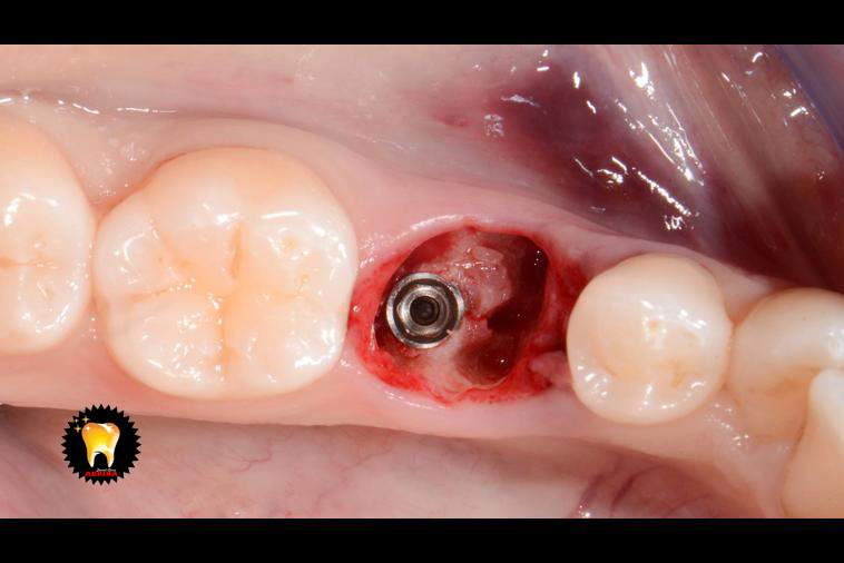 کاشت ایمپلنت دندان با روش سریع