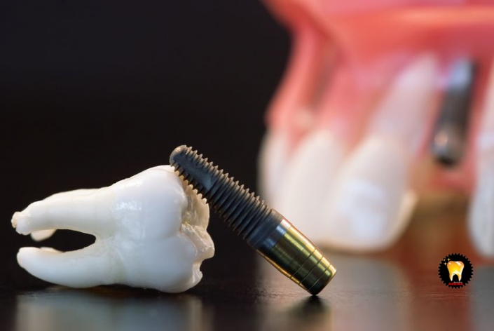 هزینه ی ایمپلنت دندان
