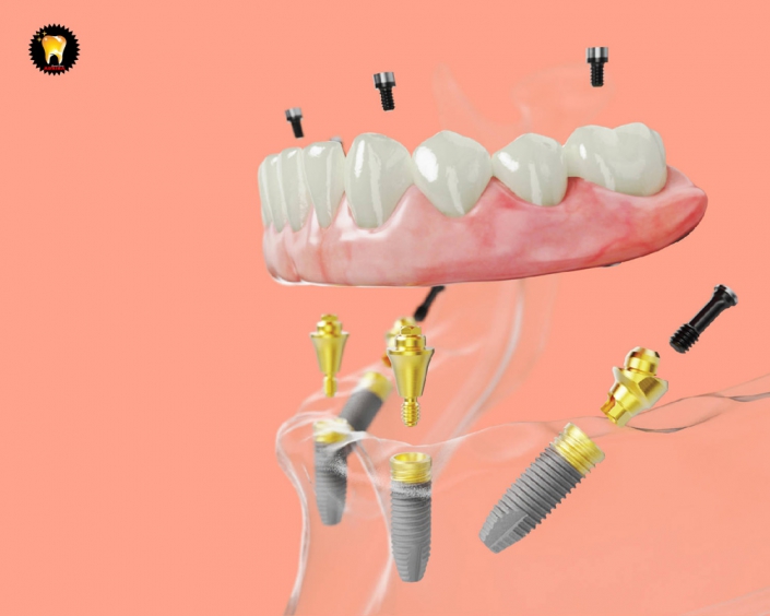 ايمپلنت و دندان مصنوعي