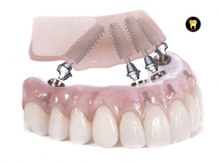 ایمپلنت دندان و جایگزین مناسب