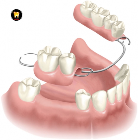 ايمپلنت دندان در شرق