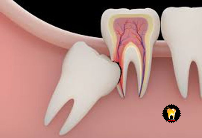 ایمپلنت دندان و سوالات متدوال جراحی