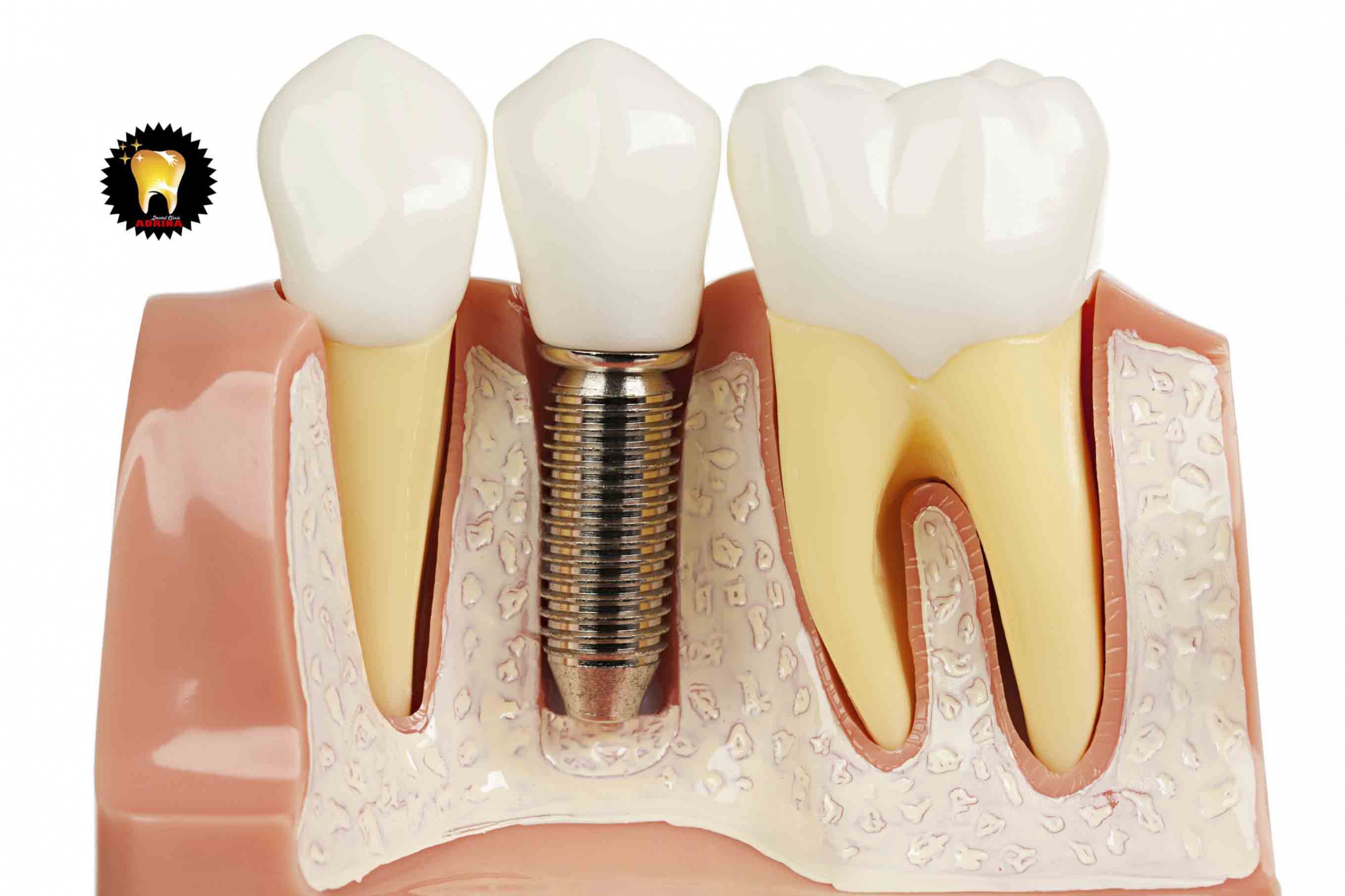انواع روش های جراحی ایمپلنت دندان 