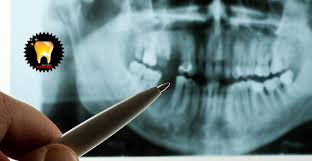  رادیولوژی ایمپلنت دندان