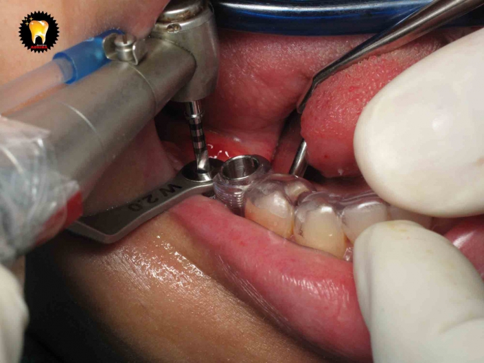 ایمپلنت دندان و مراقبت های لازم